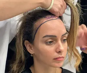 Greffe de cheveux pour femme