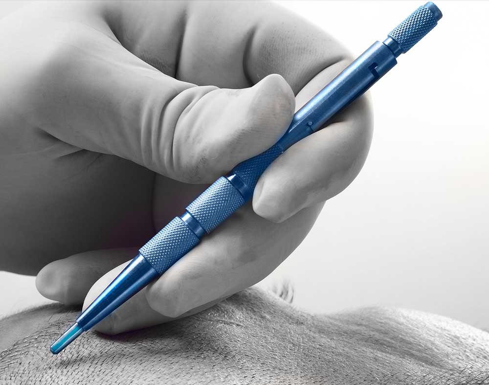 Technique FUE Saphir